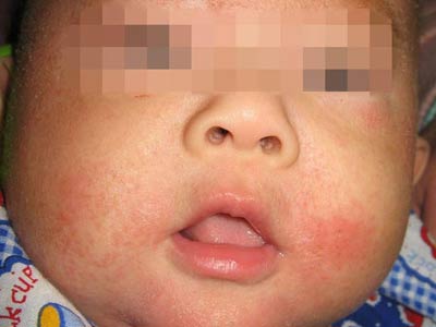 婴儿湿疹治疗方法