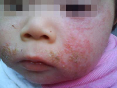 婴儿湿疹的发病带来的问题
